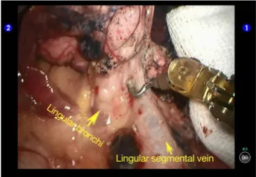 Figure 7 Dissociate the lingular segmental vein.