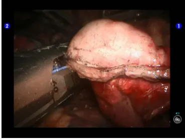 Figure 12 Clamp the lingular segmental bronchus.