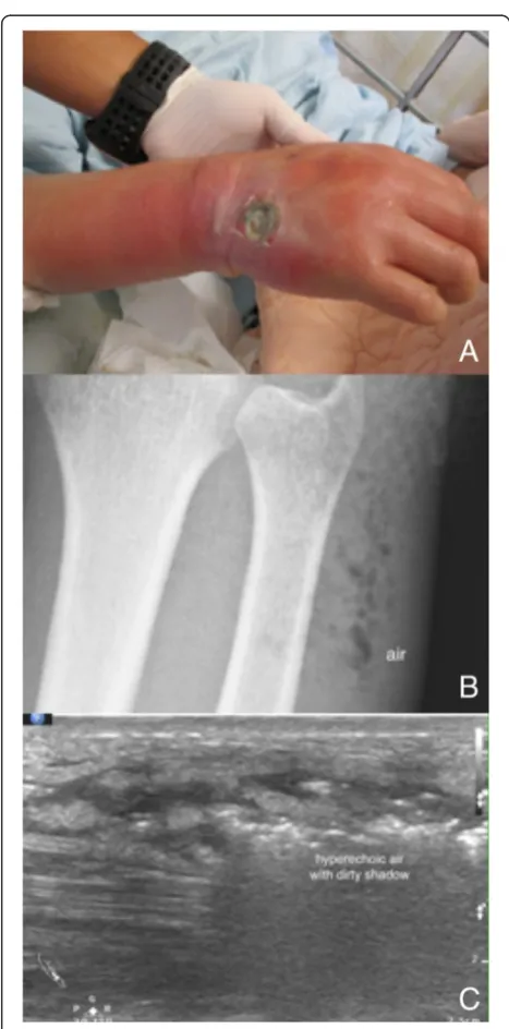 Fig. 3 Necrotizing fasciitis with soft tissue gas. A middle-aged manwith poorly controlled diabetes mellitus had a severe soft tissueinfection on his right hand and forearm (a)