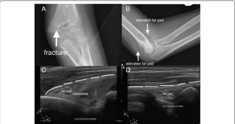 Fig. 8 Occult forearm fracture. A teenage boy injured his wrist after a fall. Initial X-ray of the wrist revealed no fracture or soft tissue swelling (a).Focused ultrasound with a linear transducer revealed a small fracture close to the growth plate (b)