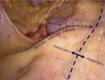 Figure 10 The conjunction between ileocolic vessels and SMV.