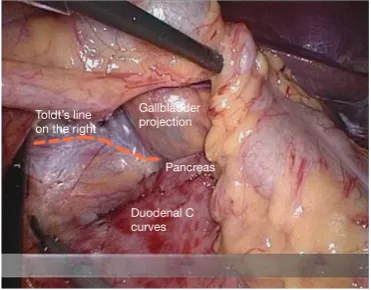 Figure 11 Adjust the vision to keep the ureter at a horizontal position.