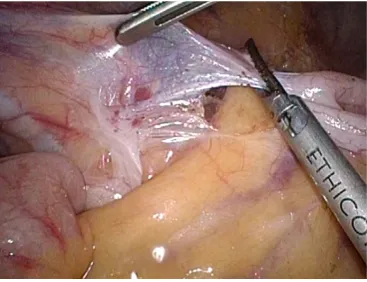Figure 19 Gastrocolic ligament transection.