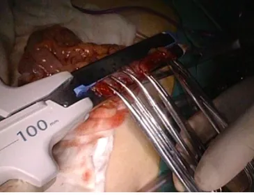 Figure 25 The 8-shape whole layer suture.