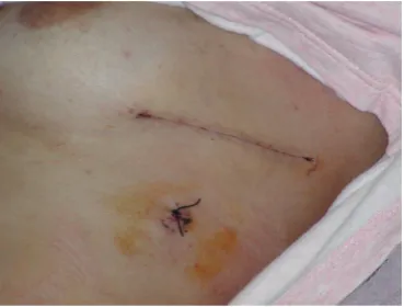 Figure 5 A single small-bore thoracostomy tube (usually 20French) was inserted and positioned in the apex of the chest cavity.