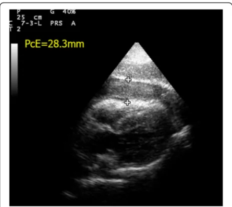 Fig. 15 Distended IVC. This is the M-mode tracing of IVC in a patientwith massive PE. The IVC is plethoric of a diameter >2.1 cm withonly minimal respiratory variation (IVC = inferior vena cava)