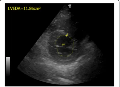Fig. 3 The normal LVEDA measurement. The LVEDA is measured at thelevel of mid-papillary level of left parasternal short axis view in a normalhuman being