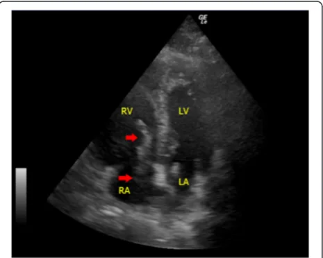 Fig. 7 Pulmonary embolism. In this apical four-chamber view, echogenicblood clots (red arrows) in the right atrium protruding into theright ventricle through the tricuspid valve during diastole are seenin a patient with confirmed massive pulmonary embolism(RA rightatrium, RV right ventricle, LA left atrium, LV left ventricle)