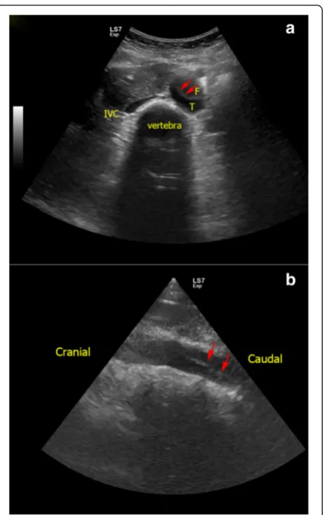 Fig. 10 atrue lumen,, b Aortic dissection of abdominal aorta. In this patientwith extensive Stanford type A aortic dissection, intimal flap (redarrows) is seen inside the lumen of abdominal aorta as an echogenicfilm separating the false lumen (F) and true 