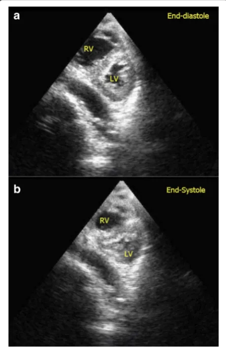 Fig. 11 a, b Severe hypovolemic shock. Kissing walls of left ventricleon parasternal short axis view is shown
