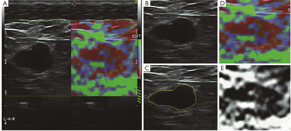 Figure 2 Dual-mode ultrasound visualization of a lymph node. (A) A dual-mode image; (B) B-mode ultrasound; (C) B-mode ultrasound with the delineated border of the lymph node (yellow); (D) real-time elastography; (E) the softness map retrieved from the colo