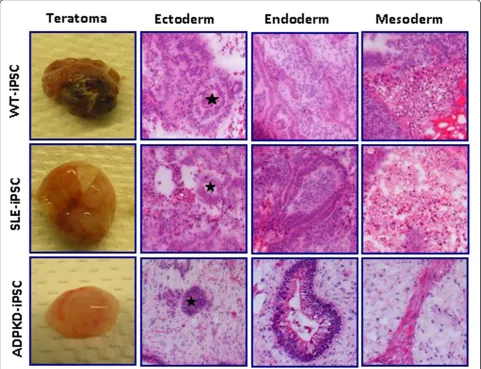 Figure 4 Wilms tumor and systemic lupus erythematosus induced pluripotent stem cells form teratoma in immunodeficient miceWilms tumor (WT)-induced pluripotent stem (iPS) cell, systemic lupus erythematosus (SLE)-iPS cell and autosomal-dominant polycystic ki