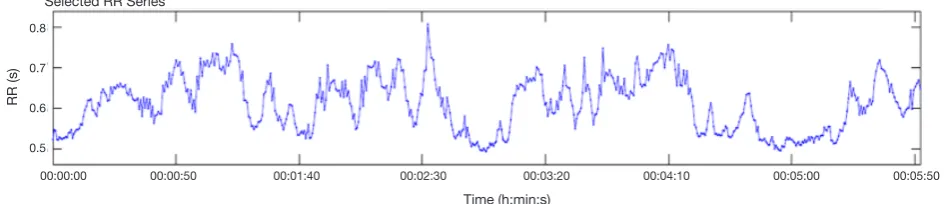 Figure 1 Subject with high heart rate variability (HRV).
