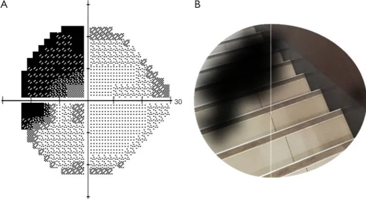 Figure 8 The artificial intelligence model to simulate the visual effects of patients with visual field defects in the real scenario
