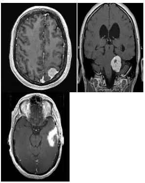 Figure 2. Brain tumor MR images Beignin type 