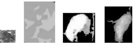 Figure 3. Brain tumor MR images Malignant type 