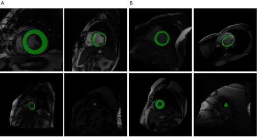 Figure 8 Segmentation results of GNNI U-net on Sunnybrook dataset (A) and LVSC dataset (B)