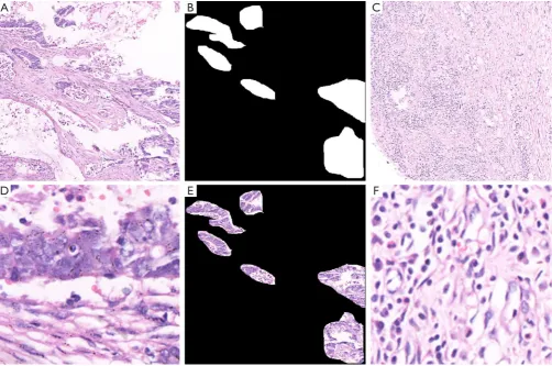 Figure 9 Overview of gastric cancer pathology. (A) Pathological image with a cancerous tissue region; (B) label region corresponding to the cancerous tissue in (A); (C) pathological image of cancer-free tissue; (D) the effect of magnifying observation of t