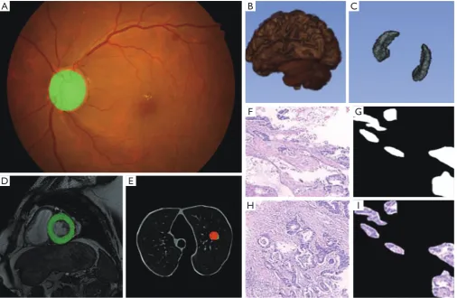 Figure 2 Deep learning application in medical image analysis. (A) Fundus detection; (B,C) hippocampus segmentation; (D) left ventricular segmentation; (E) pulmonary nodule classification; (F,G,H,I) gastric cancer pathology segmentation