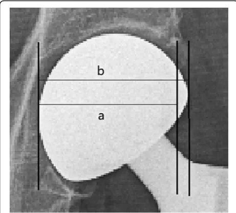 Fig. 4 Acetabular width: length of the line joining the lateral edgeof the acetabulum to the pelvic teardrop