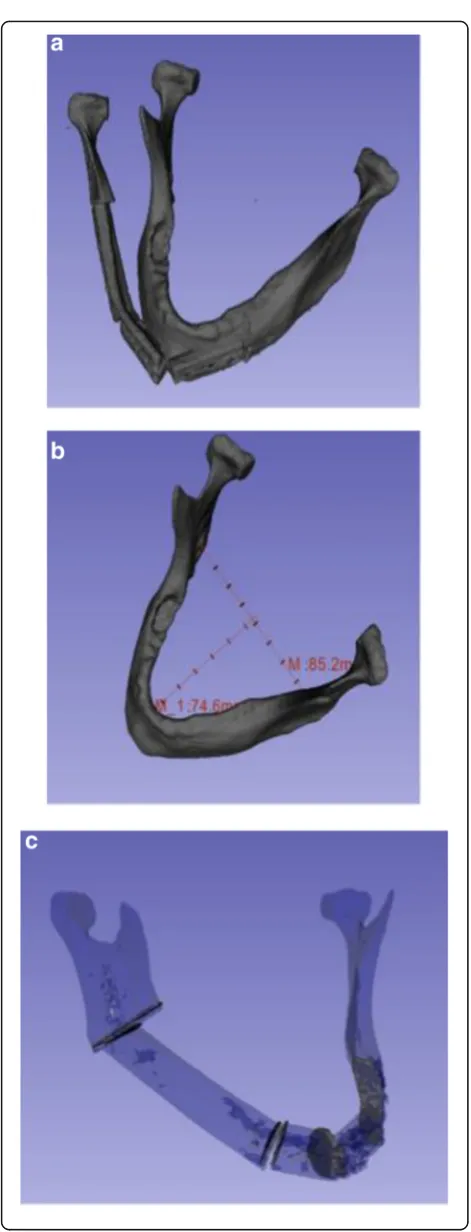 Fig. 2 Measurements of accuracy including overlap, projection, width,and gap volume between segments
