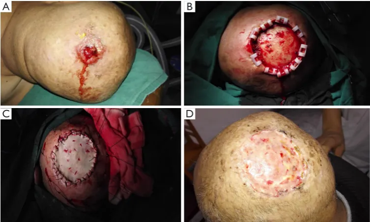 Figure 3 Skin graft in a 64-year-old male with squamous cell carcinoma. The location of the tumor at the vertex (A)