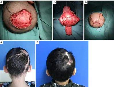 Figure 5 Free flap in a 68-year-old male with squamous cell carcinoma. The full-thickness defect at the vertex with 90 cm2 after radical resection (A)