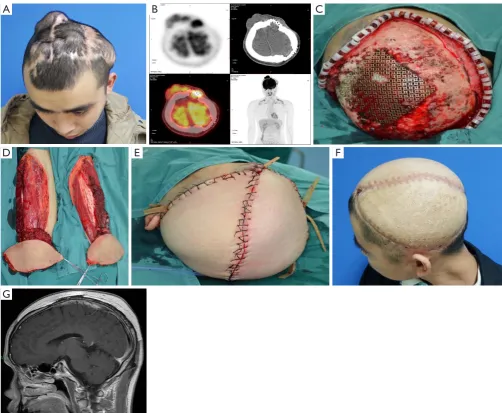Figure 7 Double Free flaps in a 29-year-old male with repeated recurrent dermatofibrosarcoma protuberan