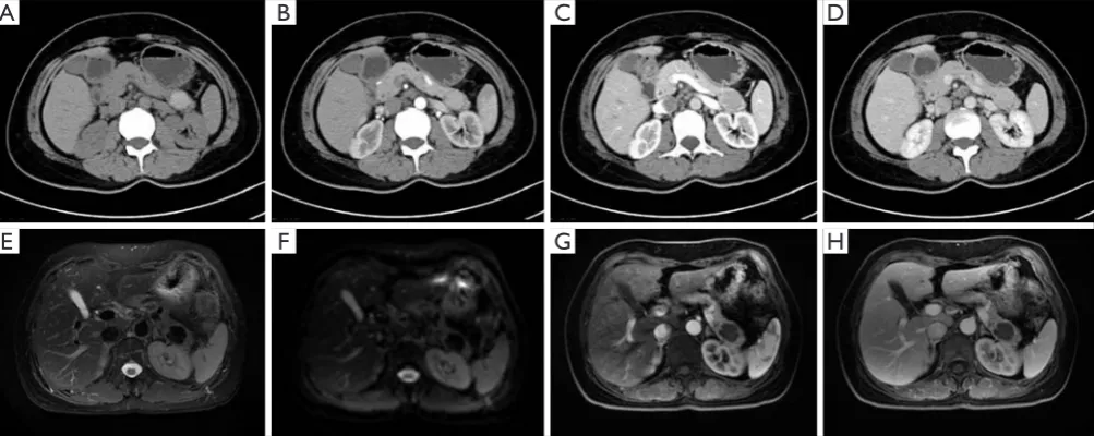 Figure 1 The CE-CT (A,B,C,D) and CE-MRI (E,F,G,H) images are demonstrating the enhanced pattern in all phases