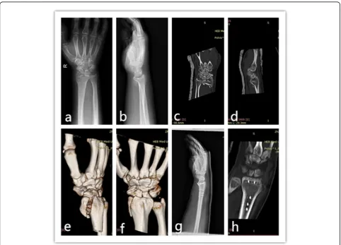 Fig. 1 Patient, male, 39 years old, suffered from motor collision accident and sustained fracture in his left wrist