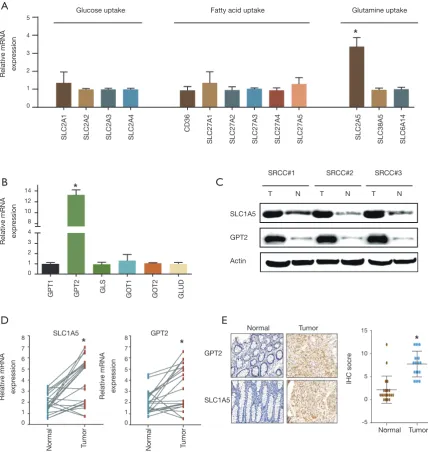 Figure 2 Metabolic genes responsible for glutamine uptake and glutaminolysis were notably highly expressed in colorectal SRCC