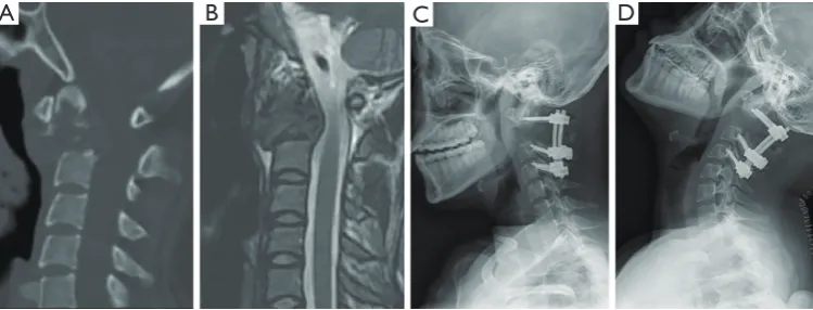 Figure 3 Imaging studies for patient #6. Preoperative CT (A) demonstrates lytic lesion involving C2 vertebra