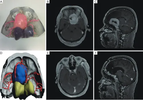 Figure S1 View of 3D-printed model (A), 3D PDF (D) and pre-operative (B,C) and post-operative (E,F) comparison of left anterior clinoid process meningioma.