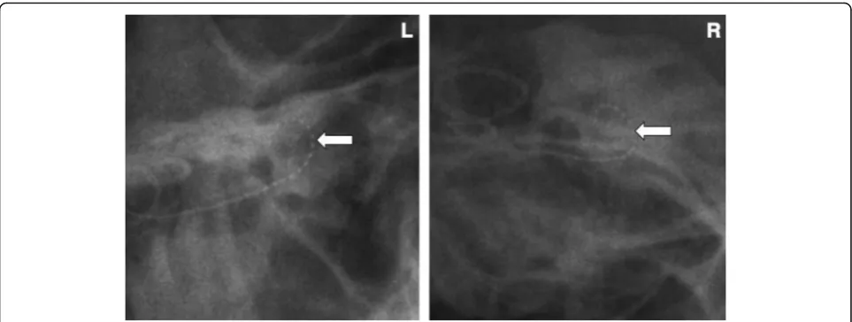Fig. 5 Left Caldwell and right Towne views. Arrows are pointing to electrode position