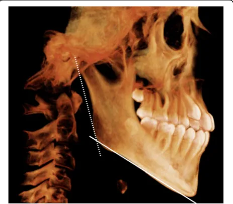Fig. 1 Lateral 3D image reconstructed from CBCT showing the gonialangle; formed by the mandibular plane (solid line) and ramus plane(dotted line)