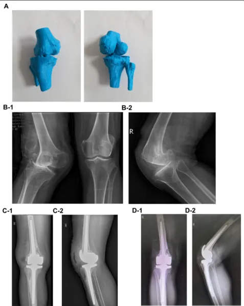 Fig. 2 A 3D printing model. Preoperative anterior-posterior view (B-1) and lateral view (B-2)