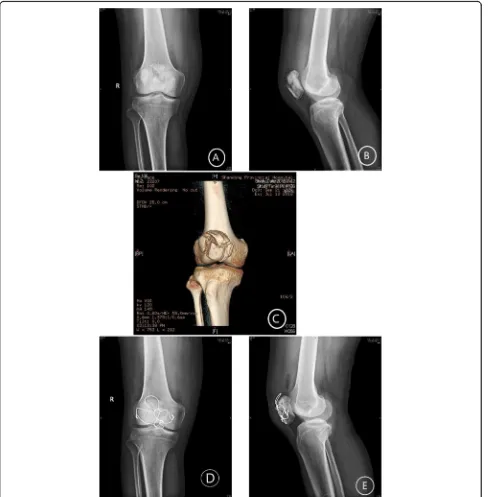 Fig. 3 A 38-year-old male with severely comminuted patellar fracture. a, b X-ray before surgery