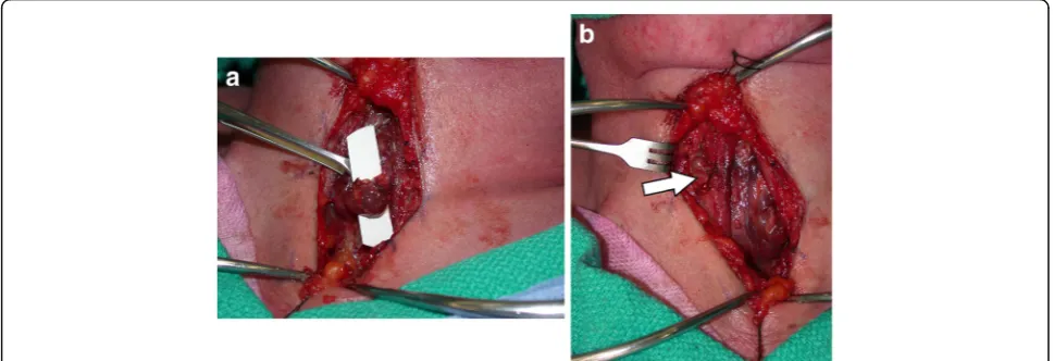 Fig. 2 Intra-operative photo of the mobilized right inferior parathyroid gland on its vascular pedicle