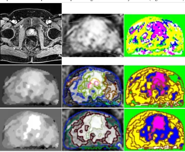 Figure 2: ROI marked by radiologist and its TIC (A), Pixel-by-pixel analysed output (B).
