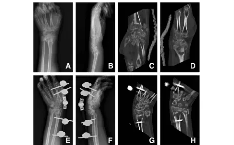 Fig. 1 AO C3.1 fracture of the left distal radius occurred in a 52-year-old woman when she fell from standing height
