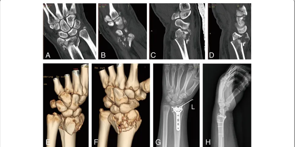 Fig. 2 AO C3.1 fracture of the left distal radius occurred in a 37-year-old man due to motor vehicle collision injury.of comminuted intra-articular fracture of the distal radius, by CT scanning and 3D reconstruction