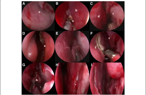 Fig. 3 Intraoperative endoscopic images. a Localisation of the sphenoid ostium at the sphenoethmoidalrecessus