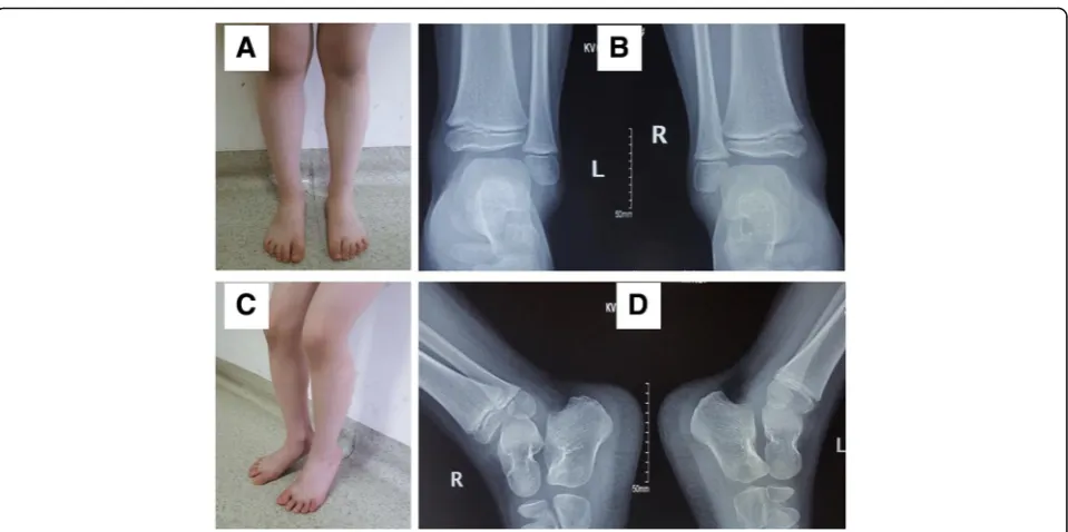 Fig. 3 General observation (a, c) and X-rays (b, d) of the patient in Fig. 1 at postoperative 2 years indicating that the fracture had healed andankle joint function had restored
