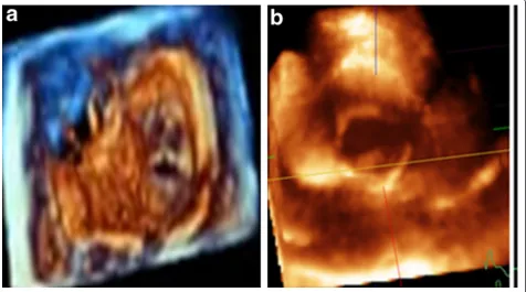 Figure 3 Morphology of malformed aortic valve cusps: Tricuspid (A) and Bicuspid (B).