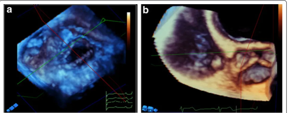 Figure 4 Enface view of tricuspid valve (A) and pulmonary valve (B) showing all valve leaflets and commissures.