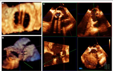 Figure 6 Enface view of ASD before (A) and after (B) device closure, and muscular VSD(C)