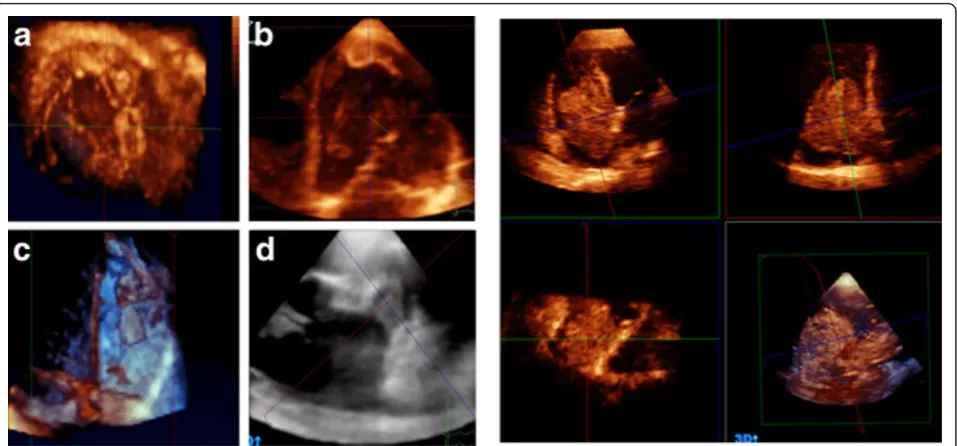 Figure 7 Left panel showing different examples of intracardiac thrombi into LV (A, B), RV(C), and LA appendage (D)