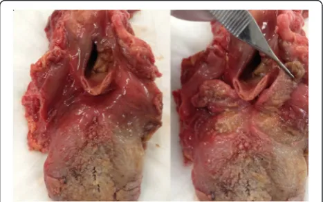 Fig. 1 Gross dissection of lingual tonsils is shown. Left image showsthe lingual tonsils before dissection and the right image shows thelingual tonsils dissected and reflected posteriorly