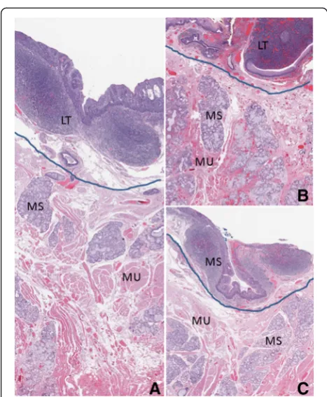 Fig. 3 Permanent sections of base of tongue biopsies with premalignant pathology. Blue line demarcates surgical plane