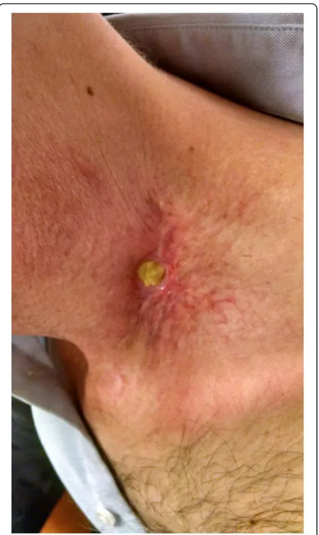 Fig. 6 Left low neck with nonhealing wound after resectionof xanthogranuloma
